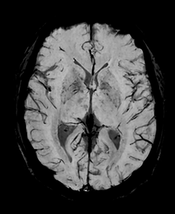Axial SWIp (minP) (fast)